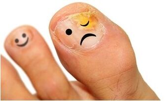 žlutá plíseň nehtů na nohou