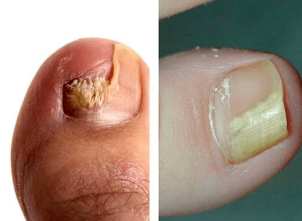 Plísňové onemocnění