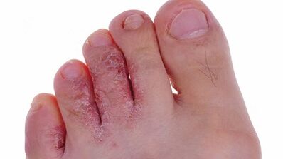 Typy a fáze vývoje houby na nohou