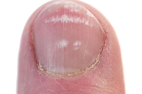 První příznaky a příznaky