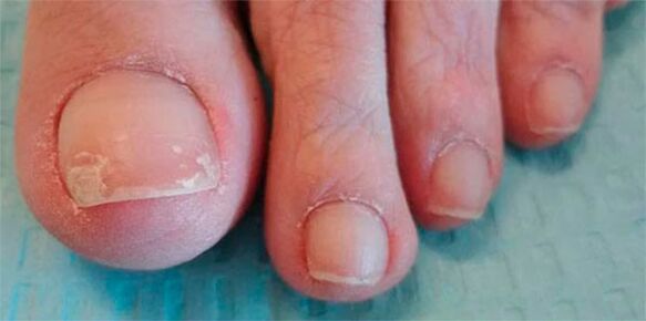 fáze plísňových nohou