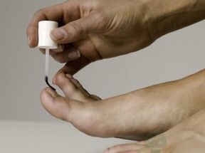 Léčba nehtových houby