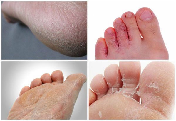 Hlavními projevy mykózy nohou jsou keratinizace kůže, praskliny, loupání