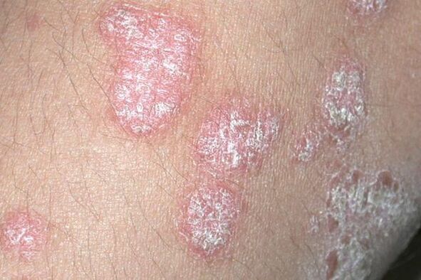 Psoriáza způsobená houbovou infekcí